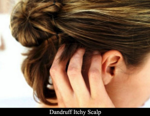 Dandruff itchy scalp